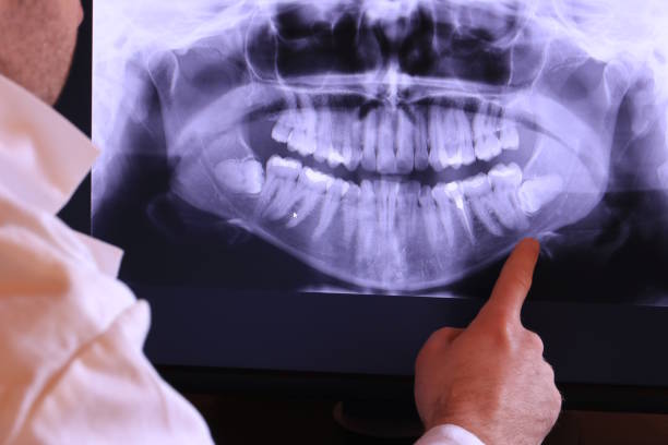 Best Emergency Tooth Extraction in Taylors, SC